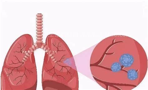 肺子上有结节是怎么回事