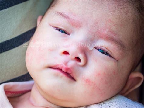 婴儿湿疹最佳治疗方法