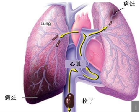 肺栓塞的治疗方法