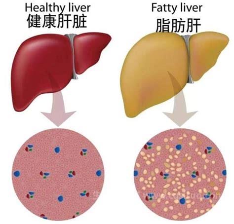 轻度脂肪肝是什么