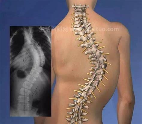 脊柱侧凸畸形有什么危害