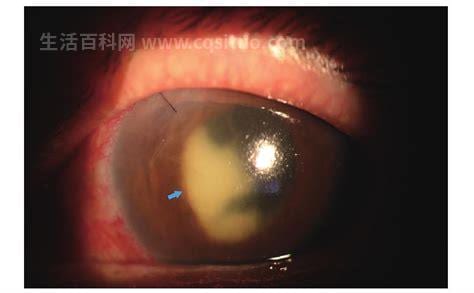 眼内炎的临床表现和治疗方式是什么