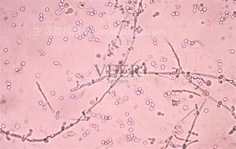 假丝酵母菌阴炎的症状
