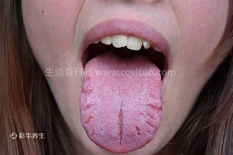 裂纹舌一般由什么引起