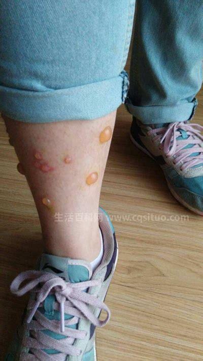 疱疹有什么症状表现