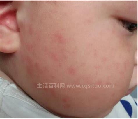 幼儿急疹出疹的护理方法