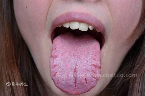 裂纹舌是什么原因引起的