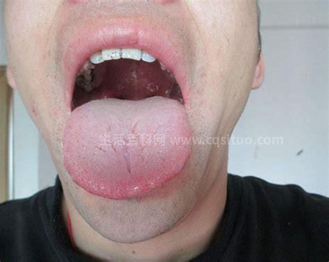 舌炎症状有哪些