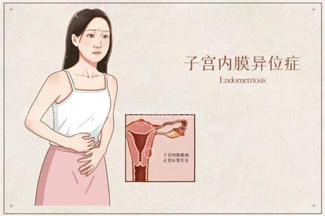 子宫异位症有哪些症状