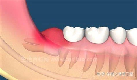 拔智齿疼吗