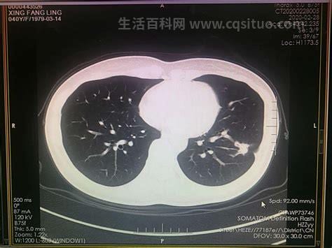 腮腺癌转移到肺部能活多久