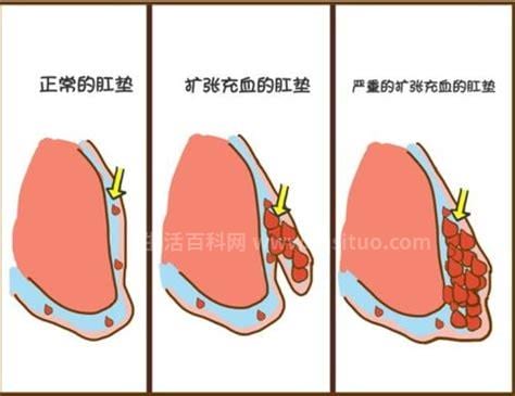 痔疮的痔核是什么