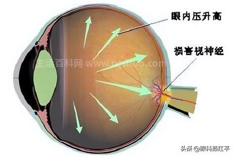 眼压是怎么回事