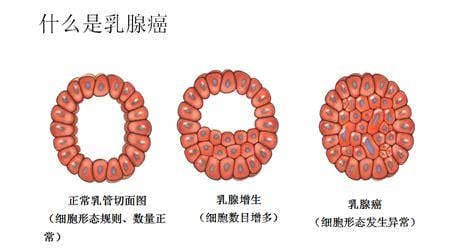 乳腺增生和乳腺癌区别