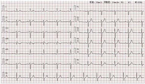 心电图左前分支传导阻滞严重吗