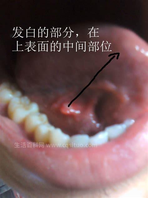 早期舌癌怎么检查出来