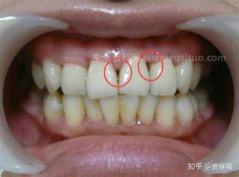 牙龈萎缩缺什么维生素