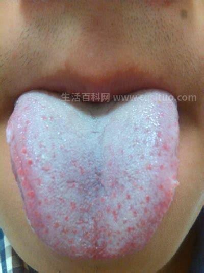 舌苔白腻厚是什么原因
