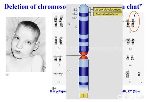 21号染色体三体有什么症状