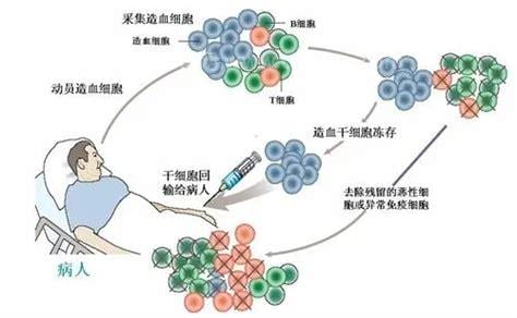 骨髓移植有什么风险