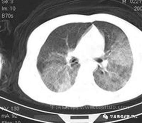 肺透明膜病症状