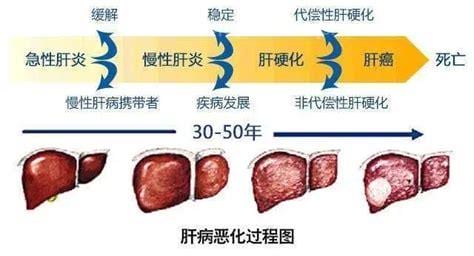 乙型肝炎症状及治疗