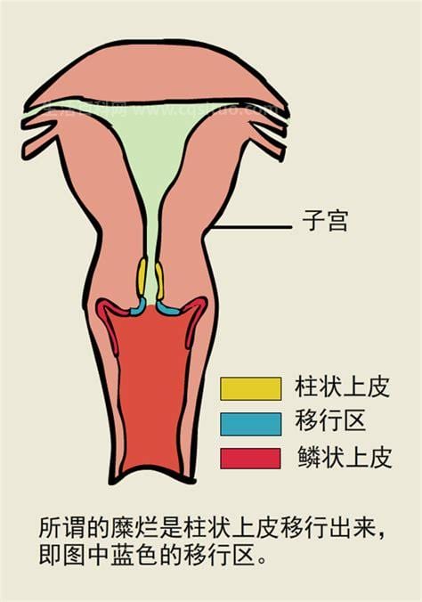 宫颈柱状上皮异位 检查