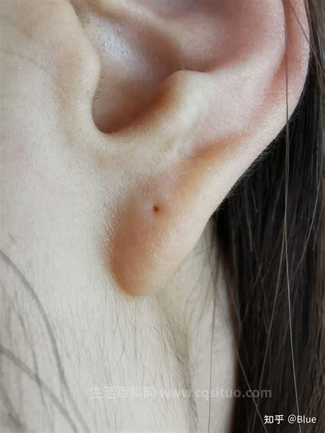 耳洞流脓要取下耳钉吗