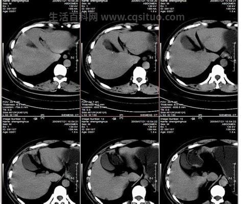 肝内钙化灶是什么意思