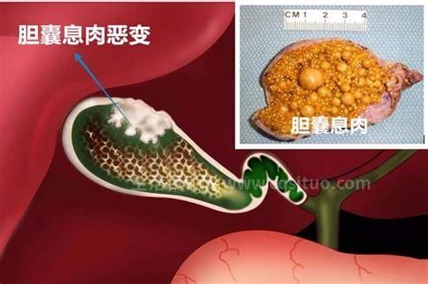 胆囊肿瘤怎么办