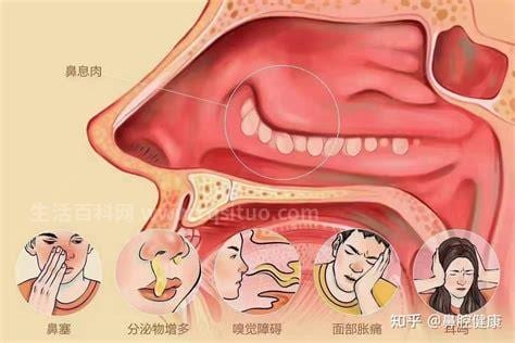 鼻息肉是怎么引发的