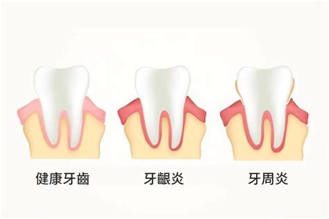 牙周炎如何治疗