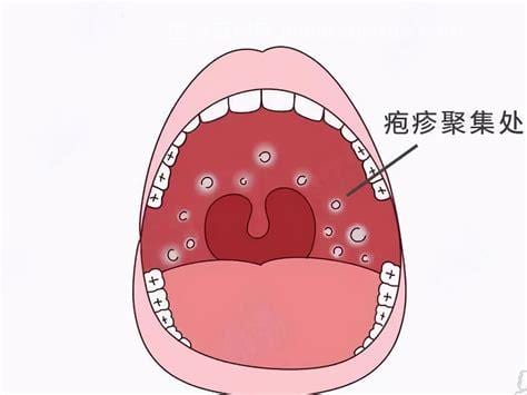 咽喉疱疹是什么症状