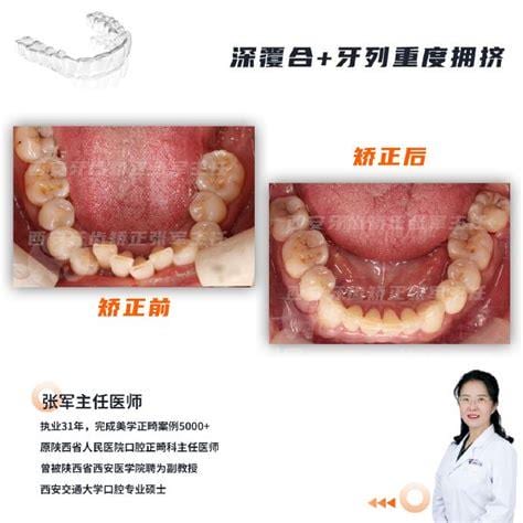 整牙的年龄限制