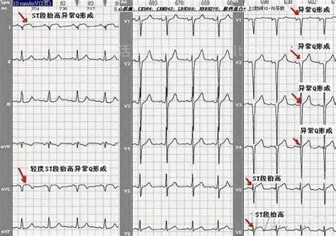 异常Q波是指什么