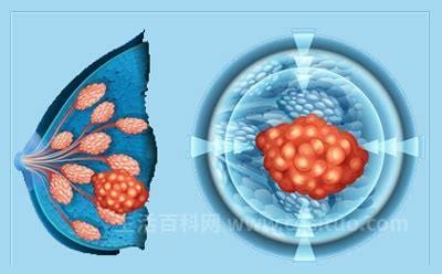 乳腺癌会传染吗