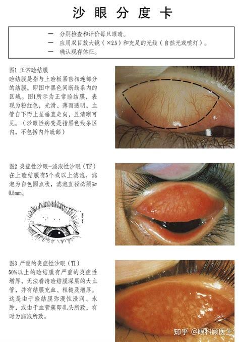 沙眼怎么引起的