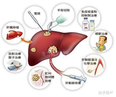 肝癌晚期症状能活多久