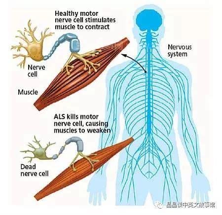 肌萎缩性脊髓侧索硬化症是什么