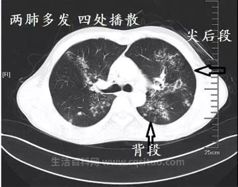 怎样判断肺结核复发了