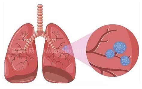 肺部有小结节能治愈吗