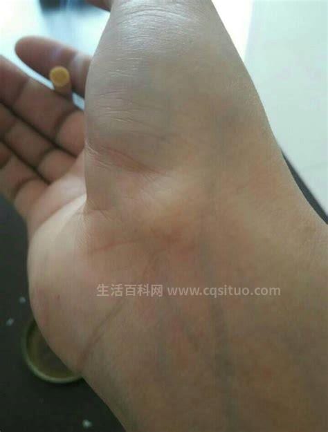 大拇指腱鞘炎治疗