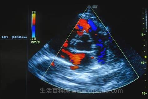 心脏彩超fs的意义