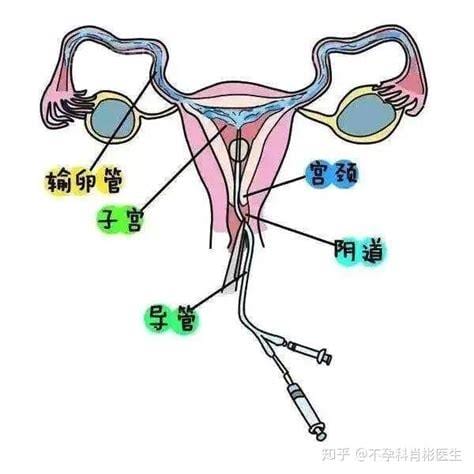 什么是输卵管通水