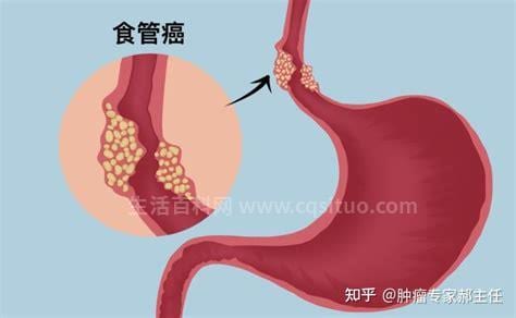 食道瘤能活多久