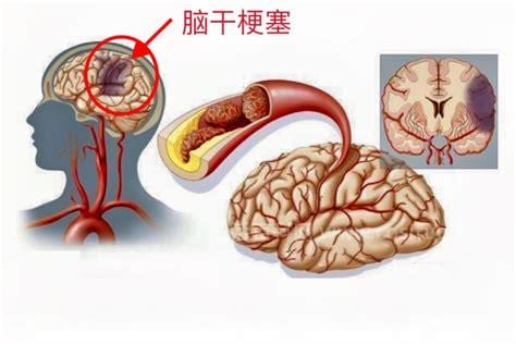 脑干梗塞症状