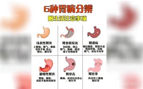 非萎缩性胃炎严重吗