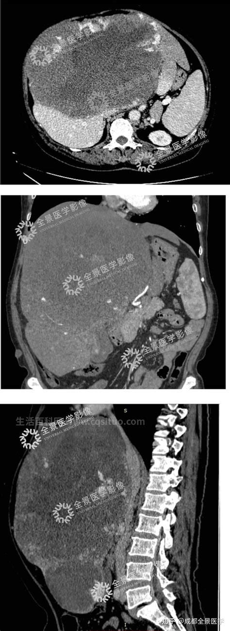 肝血管瘤近5cm能消失吗