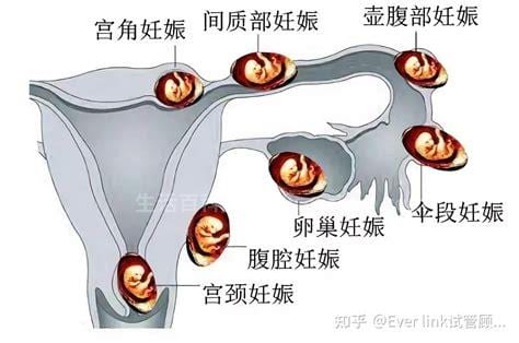 宫内妊娠是什么意思