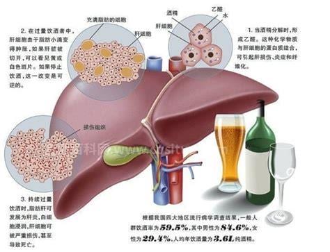 酒精肝怎么治